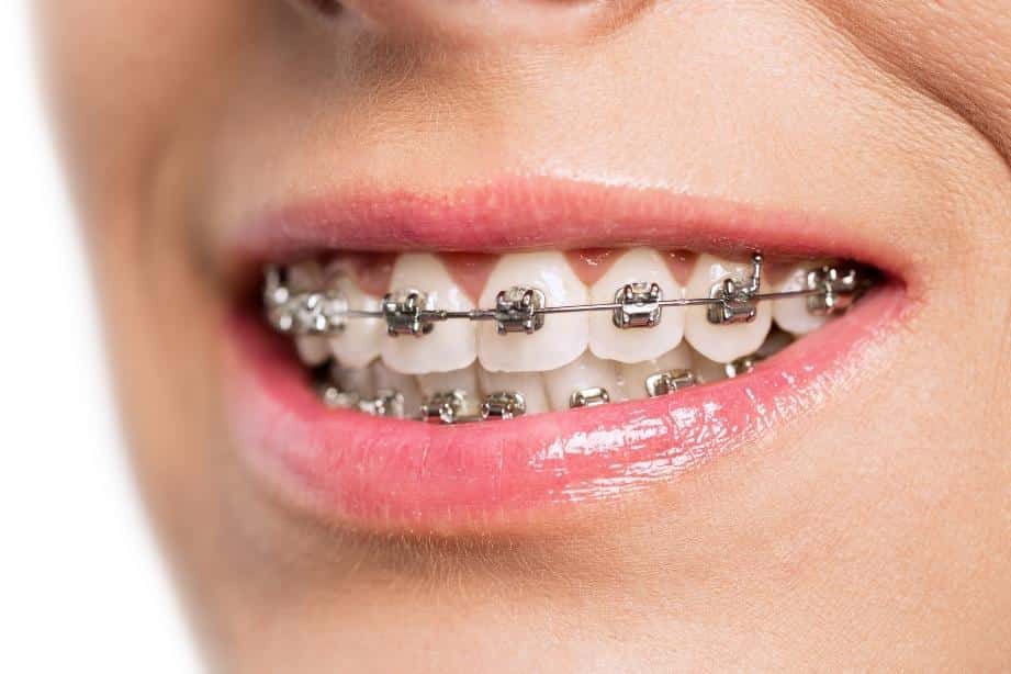 braces and orthodontics in Minnesota